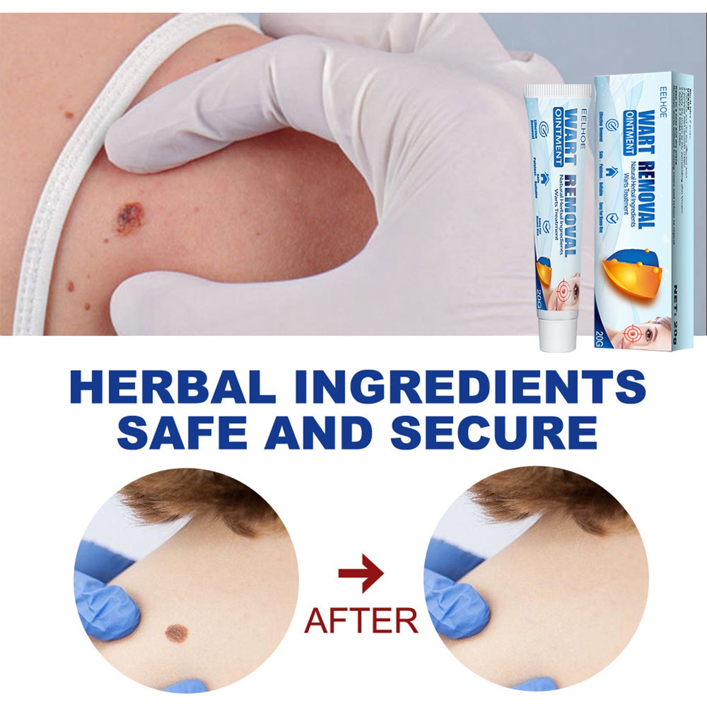 Skin Blemish and Wart Removal Cream - Natural Herbal Formula