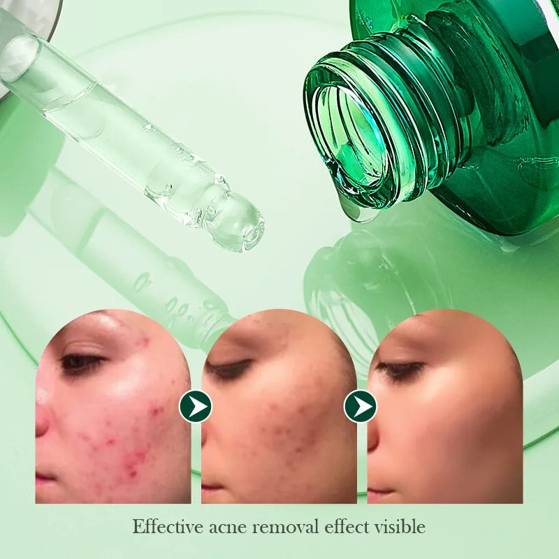 Tea Tree Hydrating Acne Control Facial Essence - 30ml
