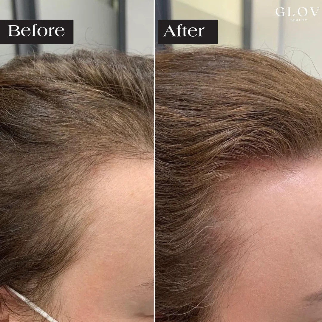 Hair Growth Microneedle Serum - 12 Vials for Hair Loss & Thinning