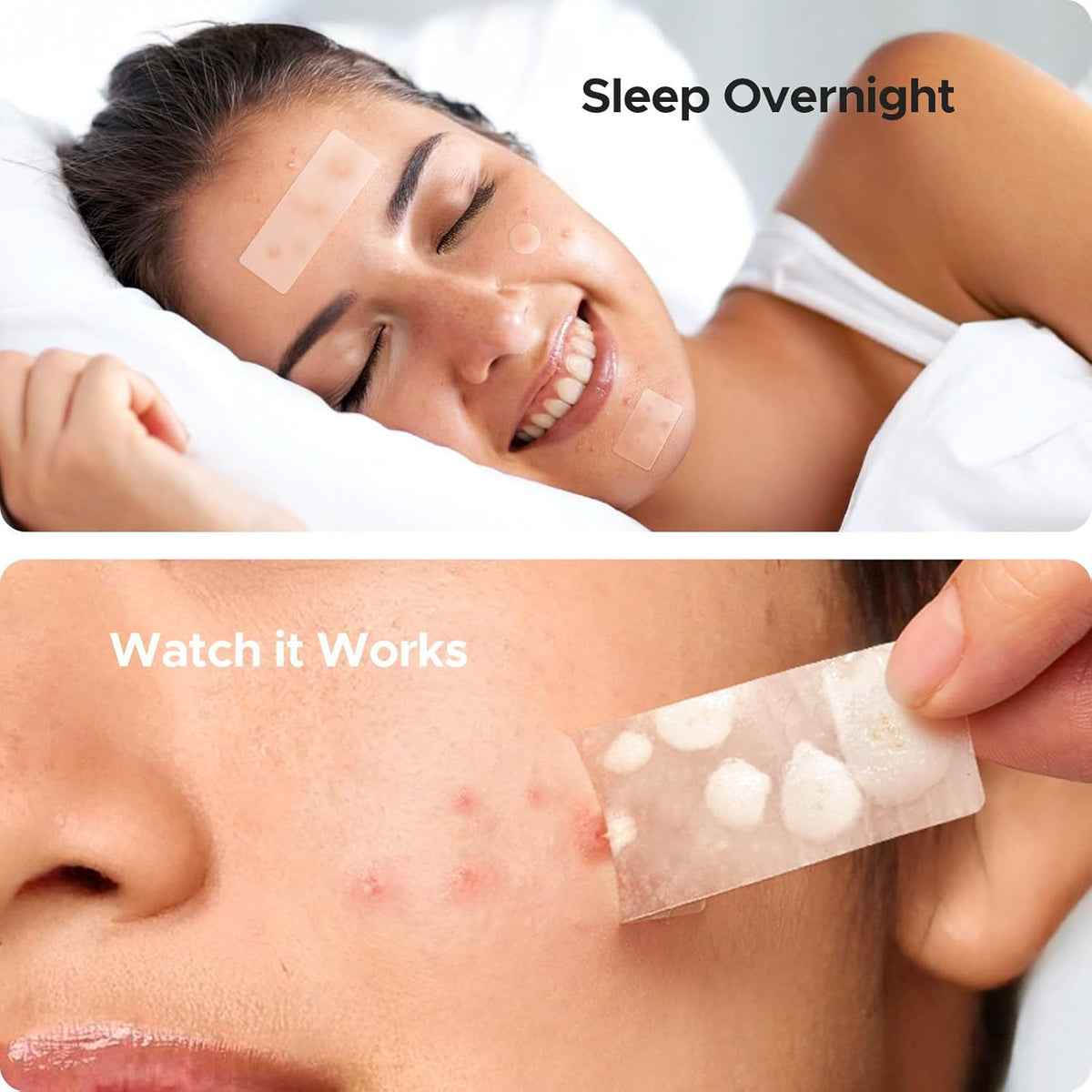 Acne Cover Patch Set 302 Pieces - Clear Skin Pimple Treatment