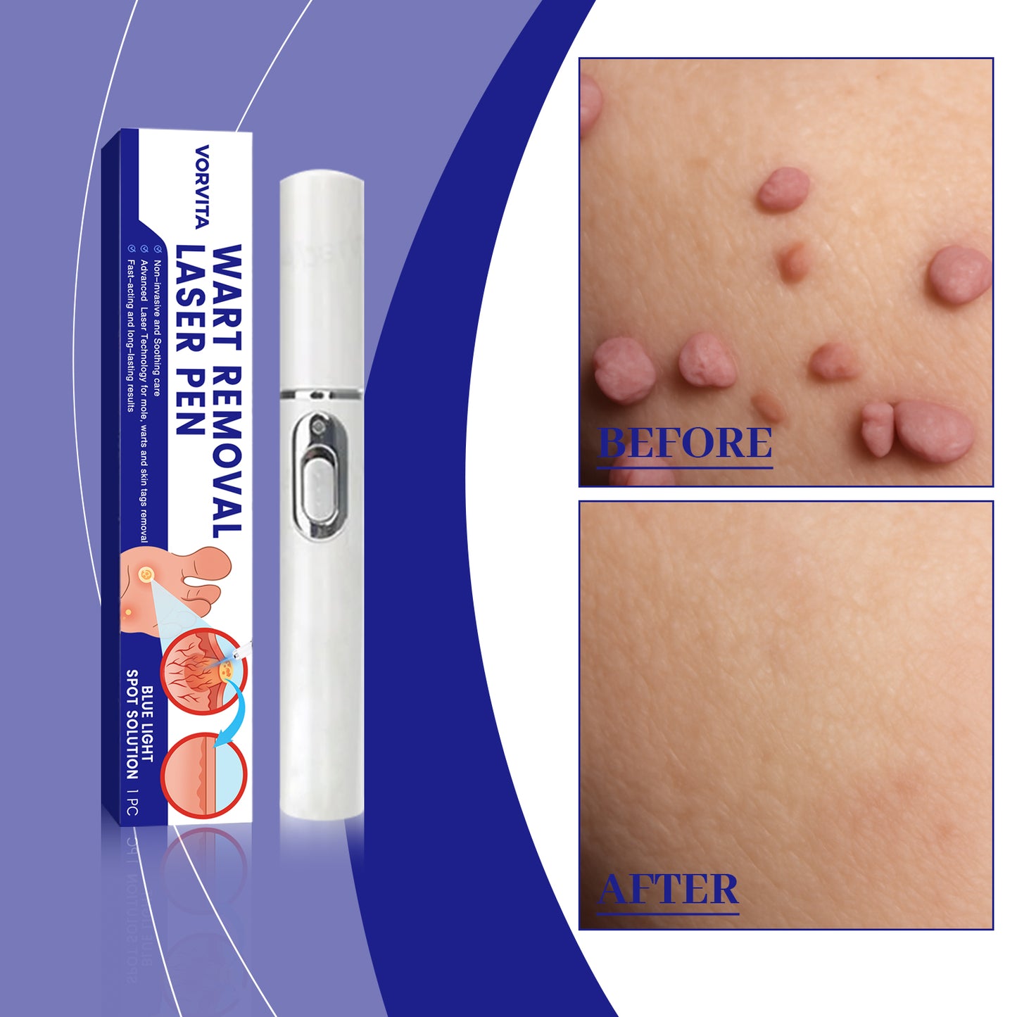 Face Skin Care Laser Pen - Anti-Aging Skin Treatment Tool